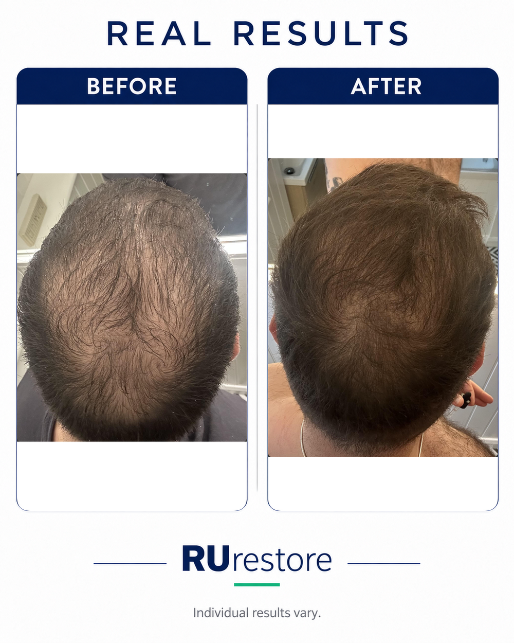 Hairline & temples, before and after